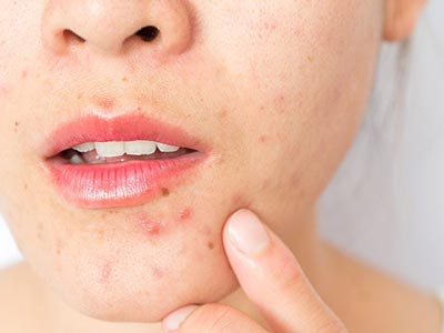 علت جوش زیر پوستی چیست؟