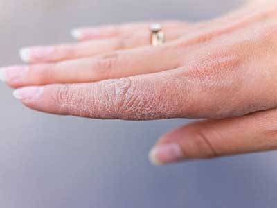 پنج مشکل رایج خشکی پوست